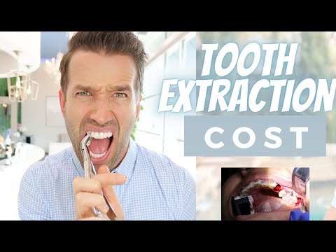 Cost of a Tooth Extraction | Teeth Extractions